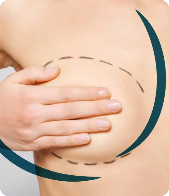 mamoplastia2